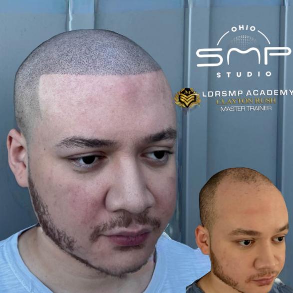 Rediscover Confidence with Scalp Micropigmentation in Reynoldsburg